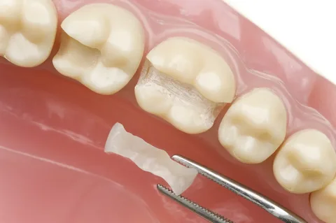 Установка вкладки вместо пломб при лечении зубов